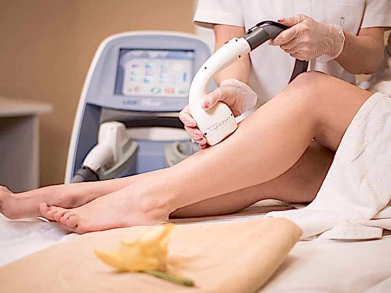 kayseri lazer epilasyon